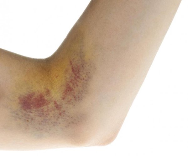 Treatment Of Yellow Bruises On The Skin | Vinmec