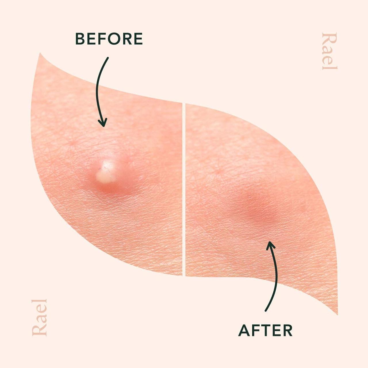 Hydrocolloid Patches 2021: Do Pimple Patches Really Work For Acne