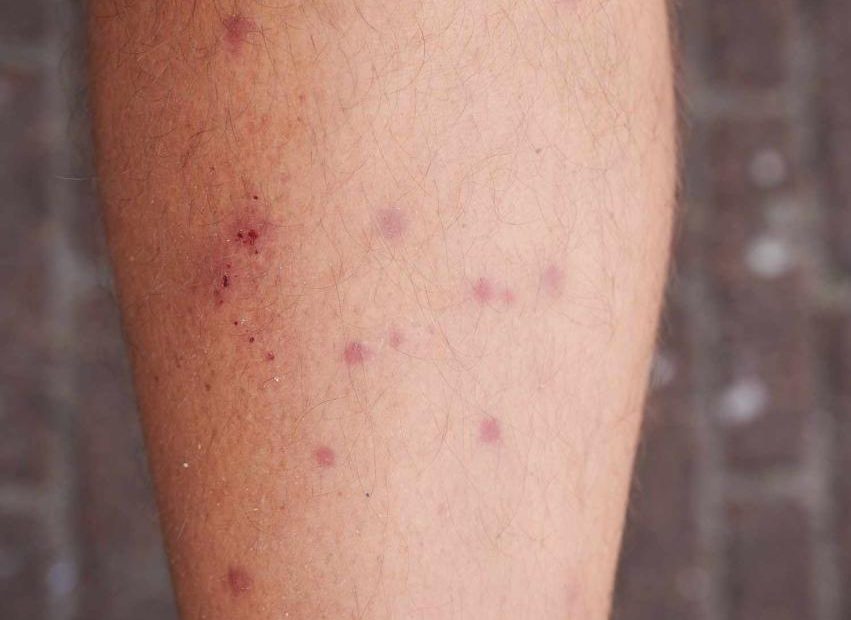 Chigger Bites: Treatment And Prevention