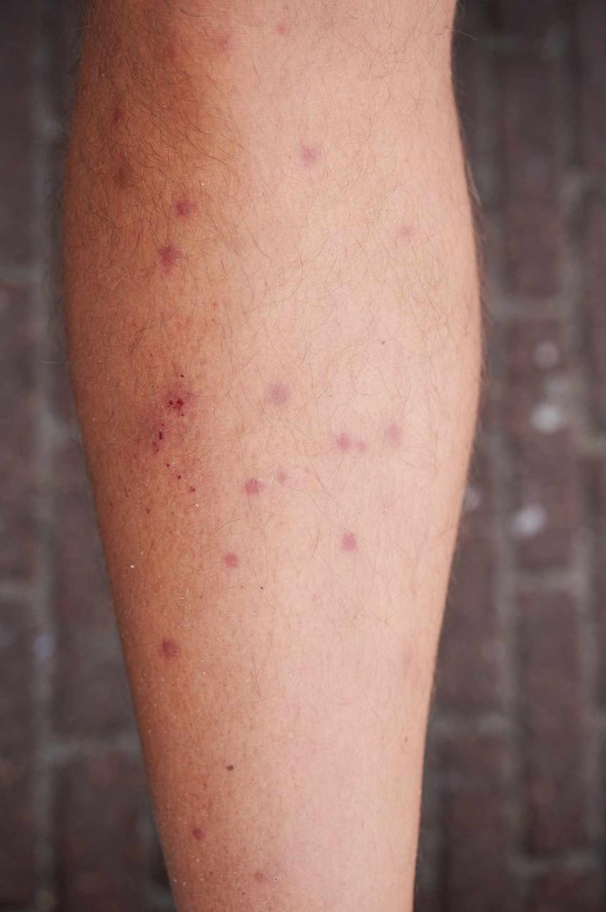 Chigger Bites: Treatment And Prevention