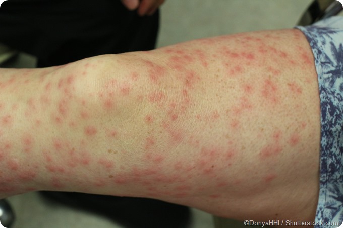 Irritant Vs Allergic Contact Dermatitis