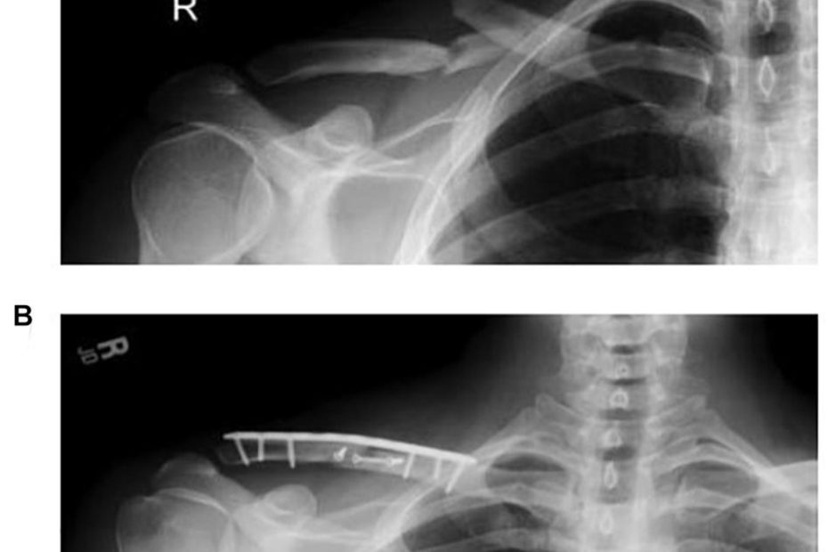 Frontiers | Effects Of Internal Fixation For Mid-Shaft Clavicle Fractures  On Shoulder Kinematics During Humeral Elevations