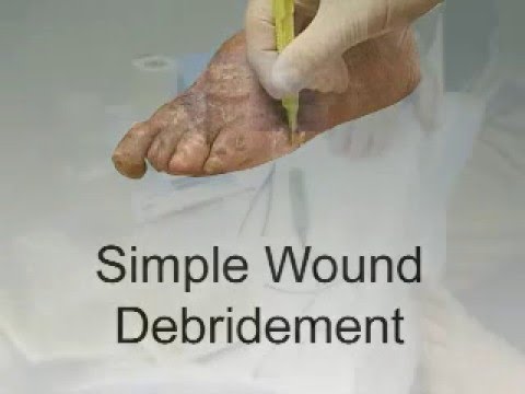 Simple Wound Debridement - Youtube