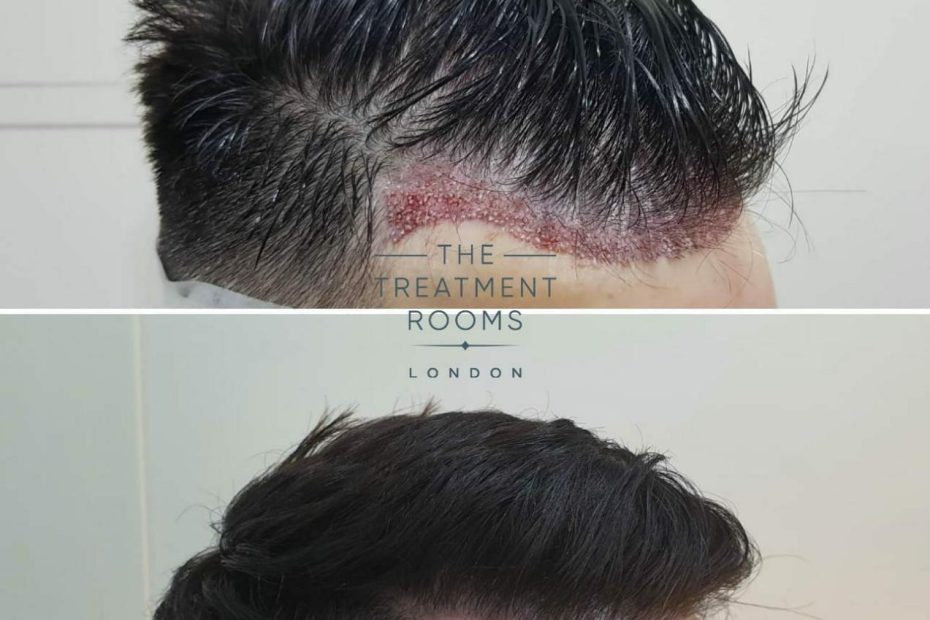 Unshaven Fue Hair Transplant (Ufue) | The Treatment Rooms London