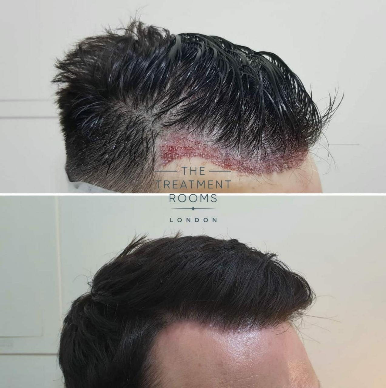Unshaven Fue Hair Transplant (Ufue) | The Treatment Rooms London
